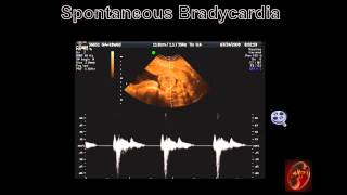 Fetal Echocardiograph Common Fetal Arrhythmias [upl. by Iran598]