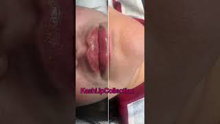 Hyaluron Pen lipfiller lips beauty skincare lipgloss aesthetic [upl. by Beetner]