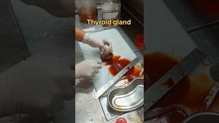 Cystic thyroid gland gross pathology [upl. by Garratt923]