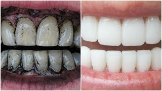 3 Way to Whiten Your Yellow Teeth Naturally [upl. by Eceinwahs]