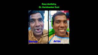 How to replace missing teeth removable partial denture shorts viralshorts [upl. by Naashar290]