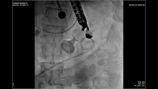 EUS GASTROJEJUNOSTOMY  FREEHAND TECHNIQUE [upl. by Crockett]