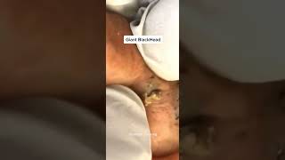 Blackheads Removal  Acne Treatment and Very Satisfying Satisfying Pimple pop blackheads [upl. by Kurzawa]