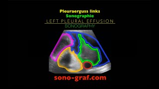 Sonographie  Pleuraerguss links [upl. by Eimaraj754]