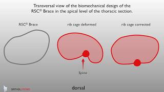 Skoliose Korsett RSC® Brace Transversal view of the thoracic section spinal orthoses biomechanics [upl. by Adnik953]