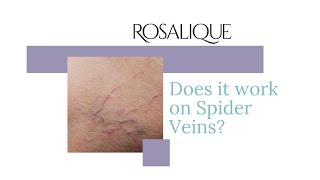 Does it work on Spider Veins  Rosalique [upl. by Tharp429]