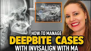 Invisalign with MA Deepbite Cases [upl. by Werby]