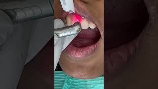 Small teeth to big teeth in 20 minutes  Quick and painless ❤️ [upl. by Laurene]