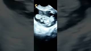 OVARIAN CYSTIC TERATOMA DERMOID CYST [upl. by Atsok]