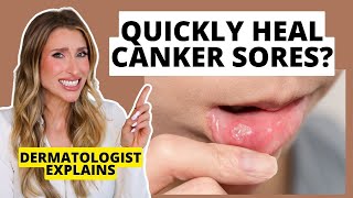 Quickly Heal Canker Sores How to Prevent amp Heal Them Faster  Dermatologist Explains [upl. by Licha]