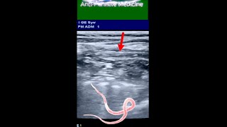 Long Ascaris Worm  in Small Intestine of 8 yrs Old Boy ultrasound [upl. by Joete]