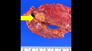 What are Adrenal Nodules [upl. by Olia]