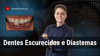 Dentes Escurecidos e Diastemas [upl. by Walkling6]