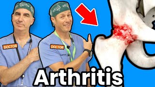 Treating Hip Arthritis Without Surgery [upl. by Luhe]