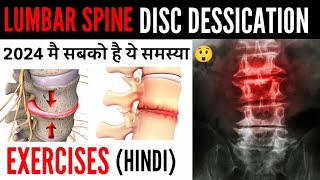 Disc desiccation with diffuse disc bulge  L4L5 L5S1 Low back pain पैरो मै दर्द  सुन्नपन जलन [upl. by Mlawsky]