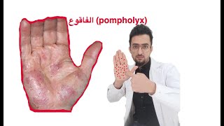 pompholyx مرض الفاقوع [upl. by Ecnaret]