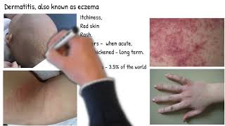 Dermatitis vs Eczema are they same Types of dermatitis symptoms prognosis and treatment [upl. by Olnton650]