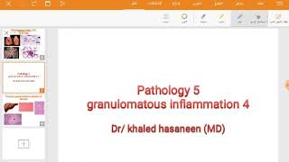 Bilharzial granulomatous reaction of the liverexample of non caseating granuloma [upl. by Dera546]