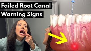 7 Warning Signs Your Root Canal FAILED [upl. by Wenger634]