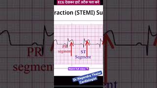 ECG से खुद हार्ट अटैक पता करे I How to read Heart attack ECG I ecg echo shorts [upl. by Carlin683]