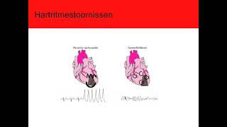 PodCast 11 Hartritmestoornissen [upl. by Arrak]