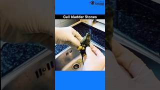 Gall bladder Stones  Laproscopic cholecystectomy  How gall bladder stones are removed [upl. by Arney90]