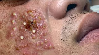 Big Cystic Acne Blackheads Extraction Blackheads amp Milia Whiteheads Removal Pimple Popping  3734 [upl. by Jarlathus]