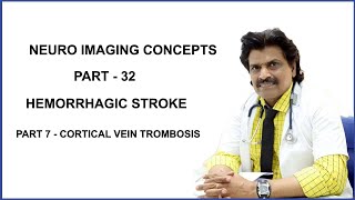 NEUROIMAGING PART32HEMORRHAGIC STROKEPART 7  CORTICAL VEIN TROMBOSIS [upl. by Nemlaz]