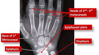 Age Estimation From Wrist Xray [upl. by Enetsirk]