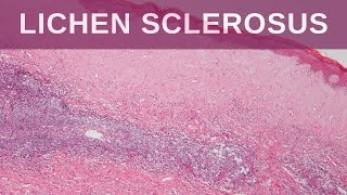 Lichen Sclerosus  Pathology mini tutorial [upl. by Gerbold196]