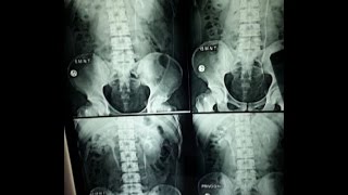 IVPIVU Intravenous UrographyPyelography BASICS OF RADIOGRAPH EXPLAINED [upl. by Mortimer]