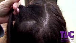 TLC Shows the difference between Lice and dandruff [upl. by Elvira]