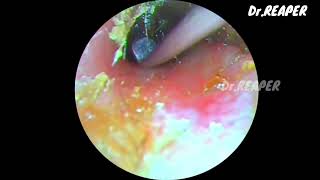 CASE NO 04  SATISFYING RESULT AT END  EAR WAX REMOVAL  LIQUIFIED WAX REMOVAL [upl. by Rosen179]