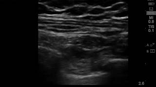 ultrasound guided intercostal nerve block 2 [upl. by Janka]