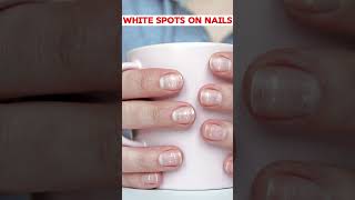 White Spots on Nails Causes and Solutions [upl. by Carpio680]