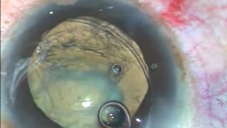 Challenges  Shallow AC Zonular dehiscence amp Vitreous upthrust  P Mohanta [upl. by Vivia558]