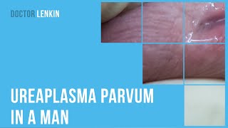 😟 Ureaplasma parvum in a man [upl. by Jagir]