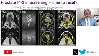 MRI in Prostate Cancer Screening  Time to Reset [upl. by Napoleon227]