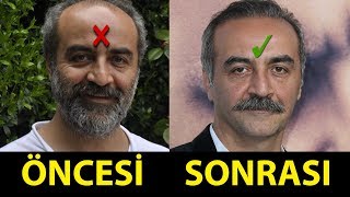 Saç Ektiren ve Protez Saç Kullanan Ünlüler Öncesi  Sonrası [upl. by Schwerin612]