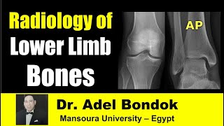 Radiological Anatomy of the Lower Limb Bones Dr Adel Bondok [upl. by Gnni]