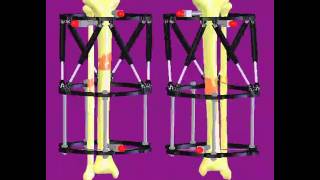 Stature Lengthening Animation LIMB LENGTHENING [upl. by Tsnre60]