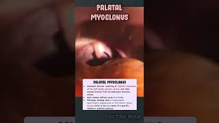 Palatal myoclonus neetpg usmle [upl. by Atiuqcir]