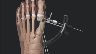 Arthrex Minimally Invasive Bunionectomy System Surgical Technique [upl. by Bree156]