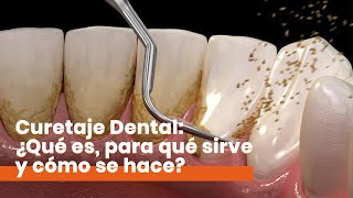 Curetaje Dental ¿Qué es y cómo se hace [upl. by Brok]