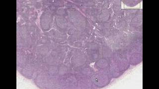 Histopathology Lymph node  Follicular hyperplasia [upl. by Attenwad]