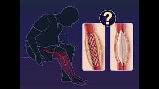 DrugEluting Scaffold for Infrapopliteal Disease  NEJM [upl. by Dalli520]