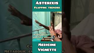 Asterixis  flapping tremors made simple for USMLE NEET PG NCLEX neet usmle medical doctor [upl. by Demp89]