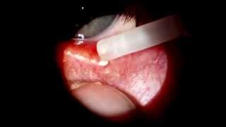 Meibomian cyst expressed [upl. by Ettesus]