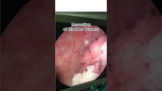 Endoscopic Removal of Bladder Tumor [upl. by Desai748]