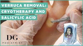 Verruca removal cryotherapy and salicylic acid [upl. by Rennane]